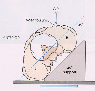 <p>Affected side raised 45°.</p>