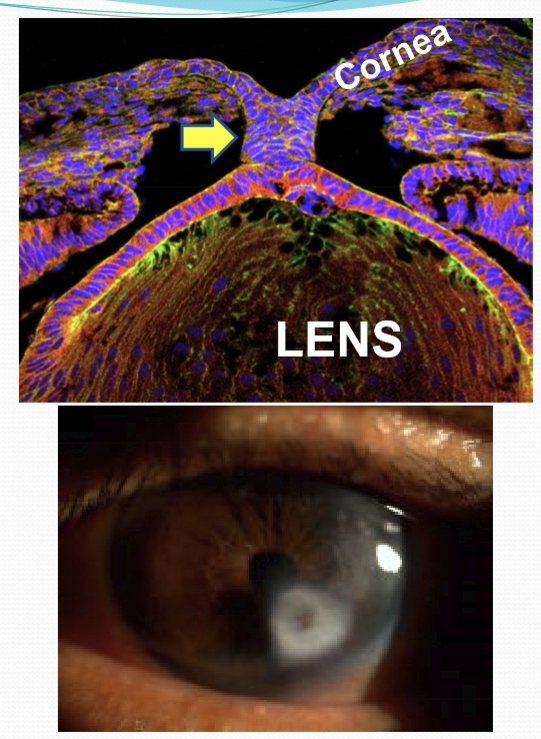 <p>When the embryonic lens vesicle fails to separate from the prospective cornea. If forms a lens stalk that is connect to the cornea and persists into the mature eye. </p>