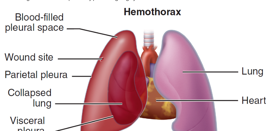 blood in the pleural space 