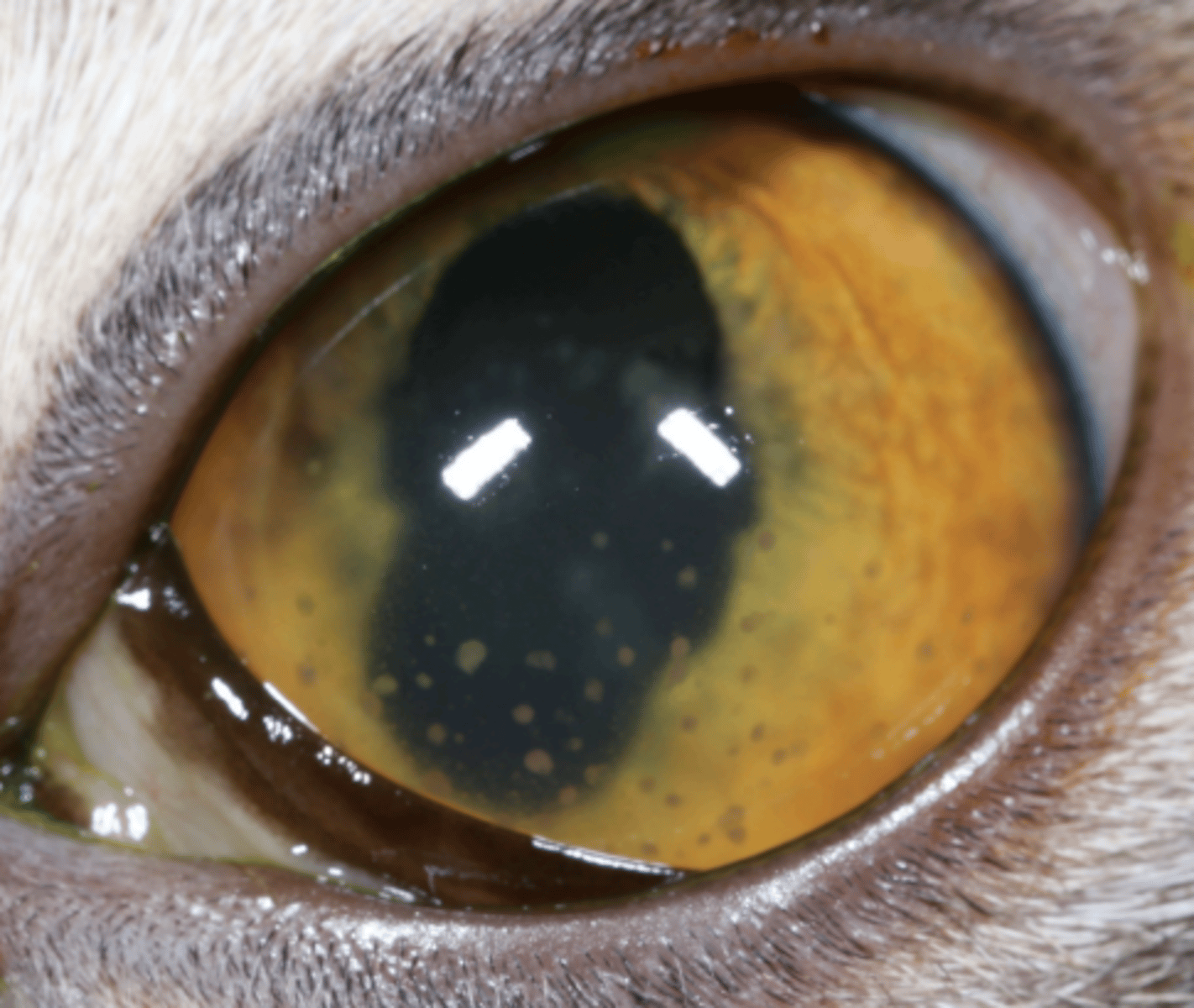<p>What am I describing?</p><p>- White opacities</p><p>- Clumps of cells, protein, fibrin, lipid adhered to endothelium, forming a scar</p><p>- Pathognomonic for anterior uveitis</p>