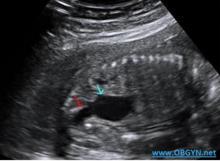 <p>a) dilated urinary bladder</p><p>b) cystic hygroma</p><p>c) double bubble</p><p>d) normal fetal abd/pelvis</p>