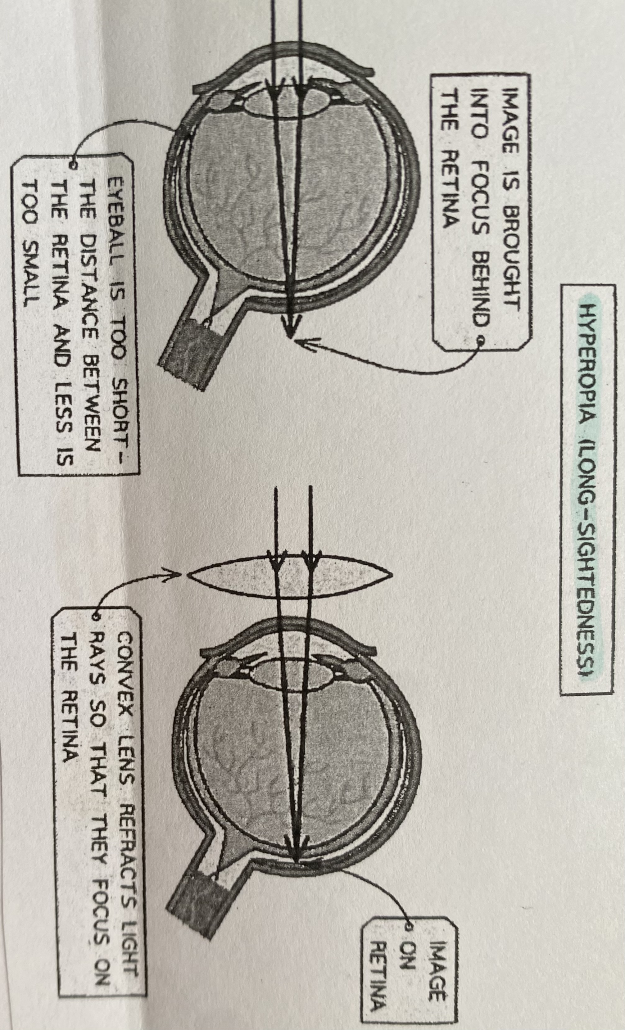<p>longsightedness = when someone can see distant objects clearly but is unable to focus on near objects </p><p>this is because the lens focuses light <u>behind </u>the retina instead of on it. Long sightedness can be caused by the eyeball being too short or the lens losing elasticity (often age related). longsightedness can be corrected by putting a convex lens in front of the eye </p>