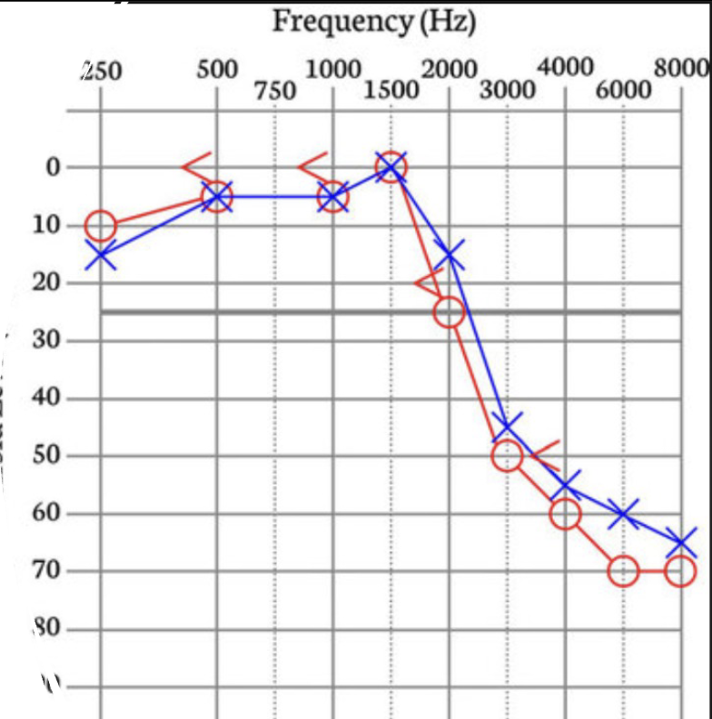<p>What does this audiogram show?</p>