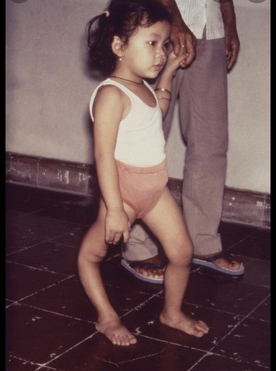 <p>choroba Heinego-Medina - ostre nagminne porażenie dziecięce</p><p>szczepionki!</p>