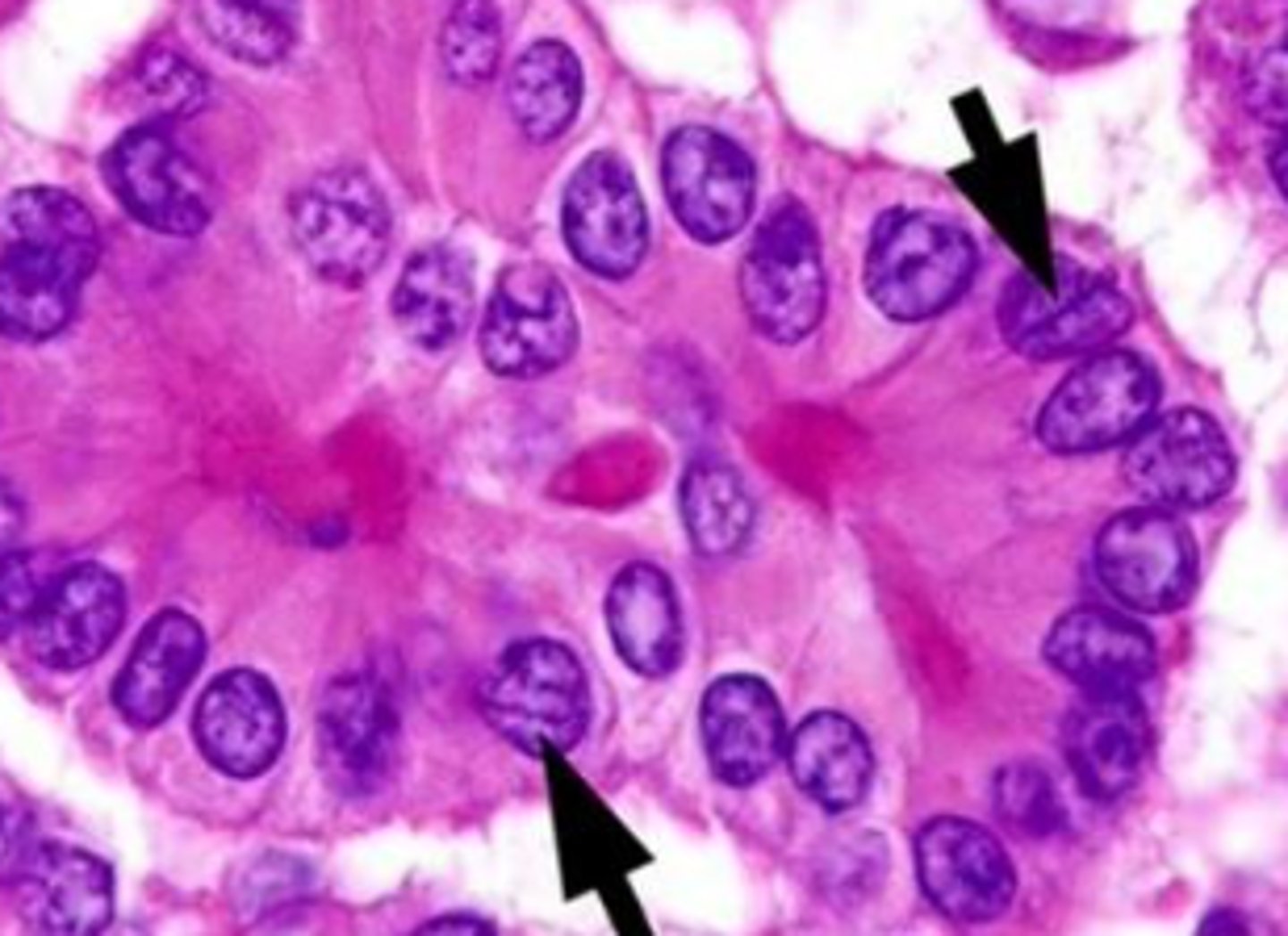 <p>intranuclear grooves of papilllary carcinoma</p>