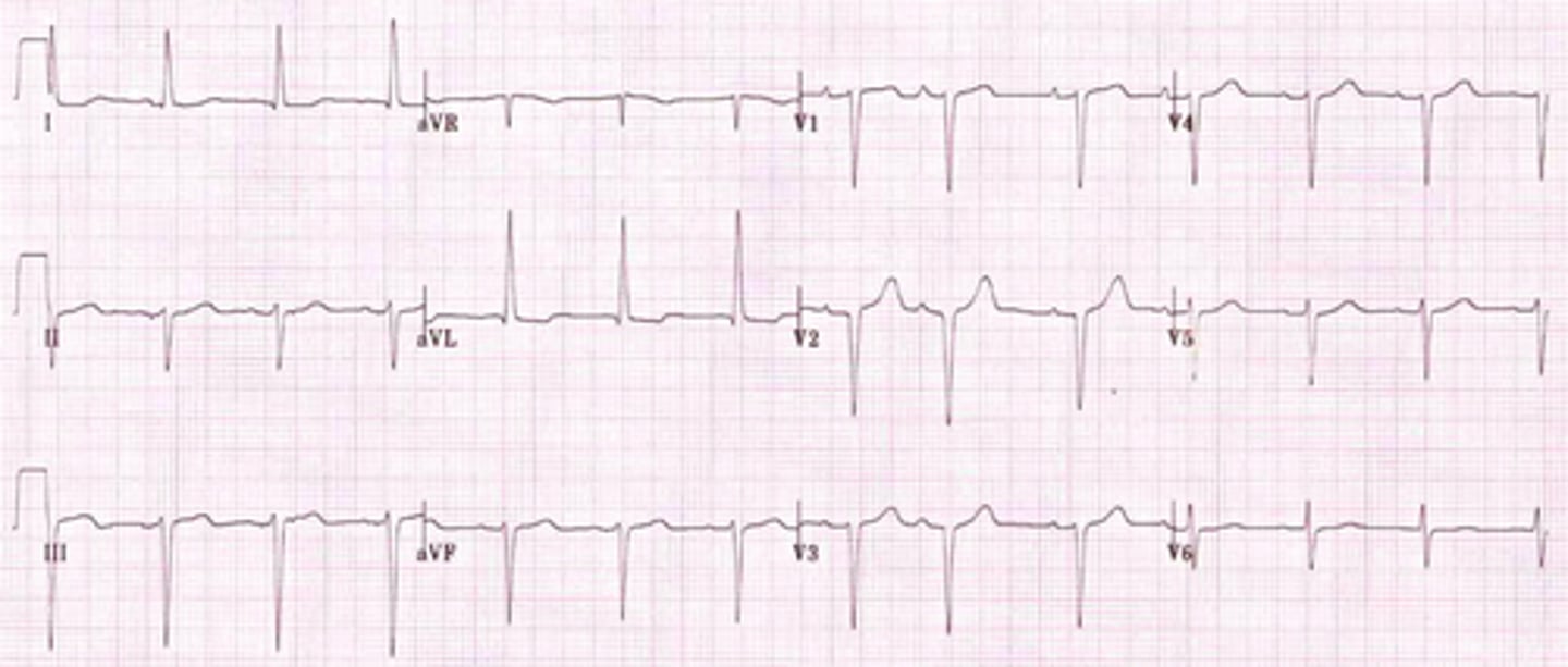 <p>If you find LAD in either lead I or lead aVF, most of the QRS complexes in lead II will be predominantly negative if it's actually present</p>
