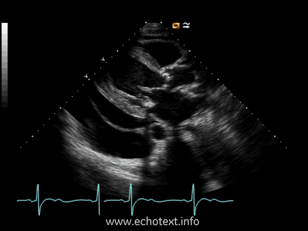 <p><span><span>The clip below is sometimes visualized after a cardiac incident, infarction or surgery, followed by acute pericarditis. What does this image clip represent?</span></span></p><p>Dressler's syndrome</p><p>Pleural effusion</p><p>Constrictive pericarditis</p><p>Pericardial effusion</p>