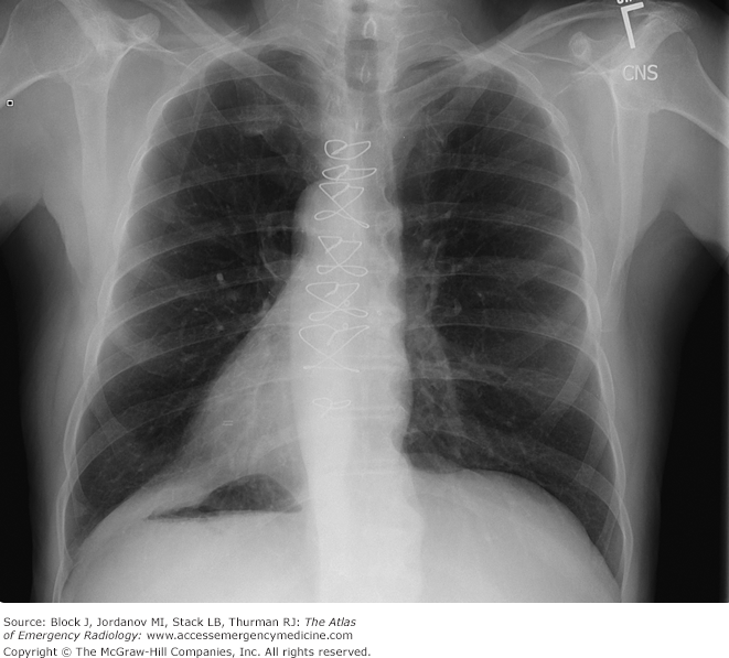 <p>Situs inversus totalis</p>
