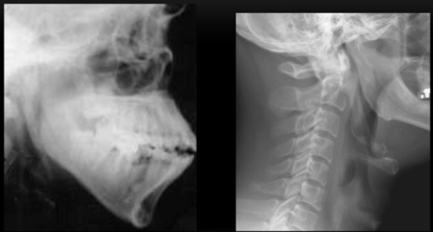 <p>carotid artery syndrome</p><p>mild cases: none except reassurance or local corticosteroids to relieve pain</p><p>severe caess: surgical intraoral excision of the process</p>