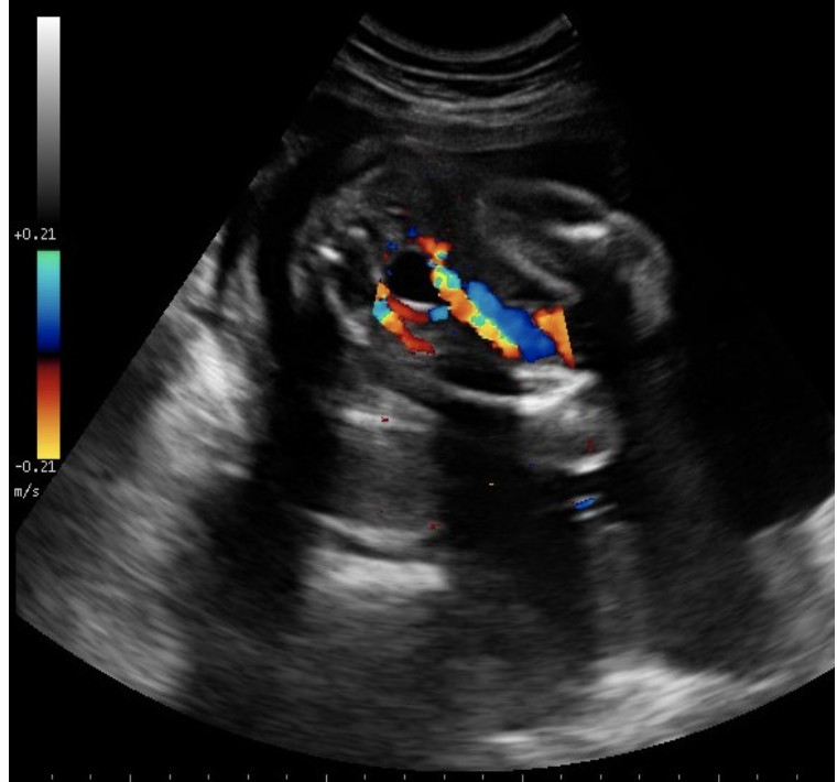 <p>what is true</p><p>a) normal cord w/2 arteries</p><p>b) transverse view at the level of stomach </p><p>c) shows 2 vessel cord</p><p>d) shows lumbar spine + pelvic bones</p>