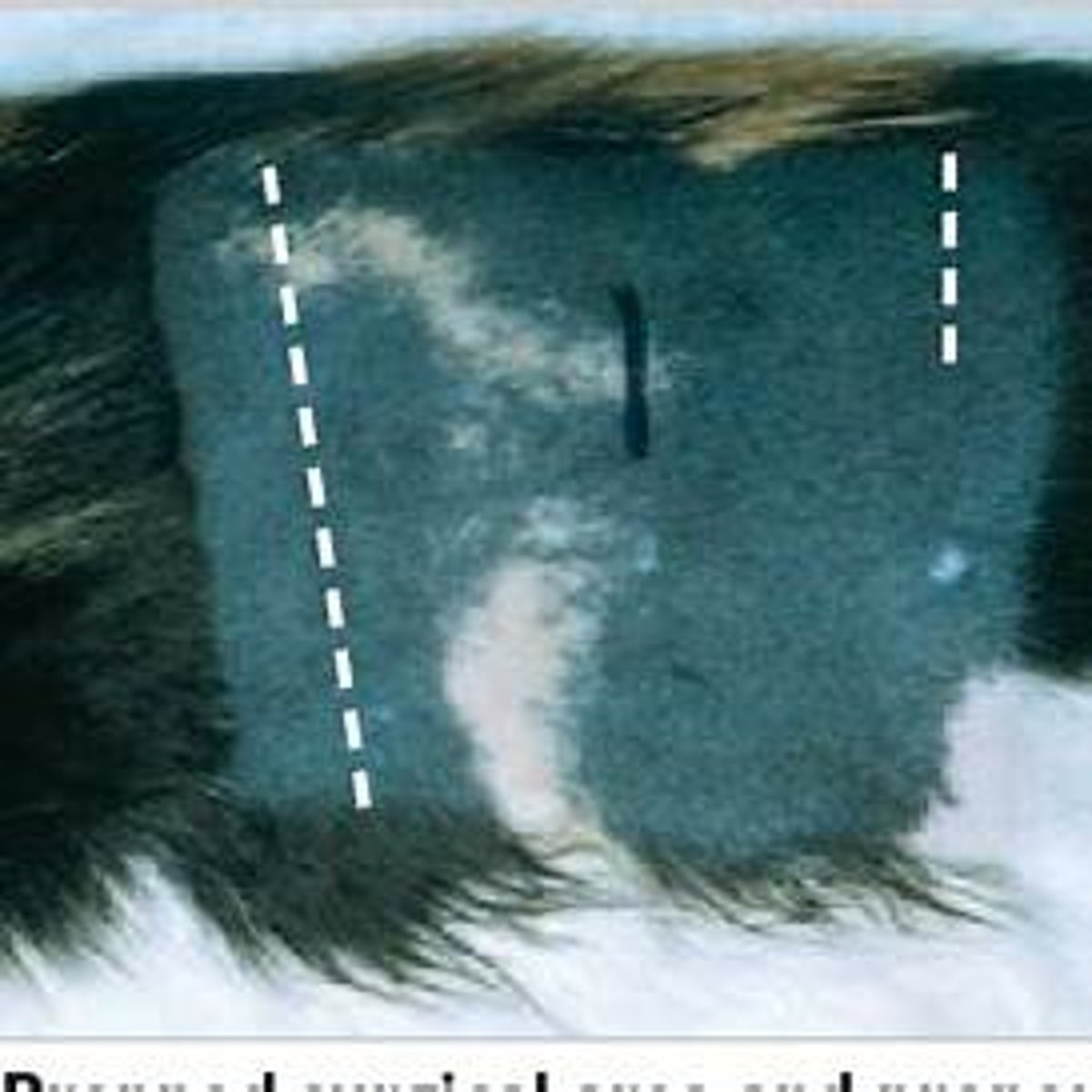 <p>Midline Approach:</p><p>Incision Location: The incision is made along the midline of the abdomen, usually just below the umbilicus (belly button) to allow access to the ovaries and uterus.</p><p>Landmarks: The incision is typically made on the midline at the midpoint between the umbilicus and anterior brim of the pubis.. The skin and muscle layers are carefully separated to reach the reproductive organs.</p><p></p>
