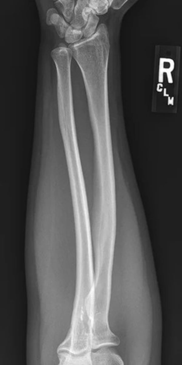 <p>more focus on radius and ulna</p>