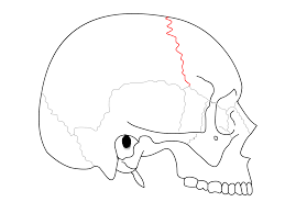 <p>Between frontal and parietal bones</p>