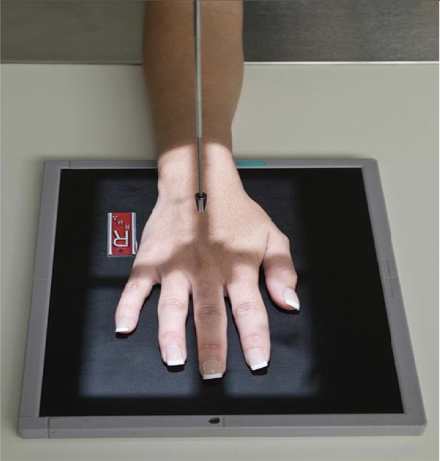<p>Patient Position</p><ul><li><p><span style="line-height: normal;">&nbsp;</span>Sitting at side or end of table</p></li><li><p class="p1"><span style="line-height: normal;">&nbsp;</span>Humerus abducted; elbow flexed 90<span style="line-height: normal;">&nbsp;degrees</span></p></li><li><p class="p1"><span style="line-height: normal;">&nbsp;</span>Forearm resting on table</p></li></ul><p class="p1">Part Position</p><ul><li><p class="p1"><span style="line-height: normal;">&nbsp;</span>Hand is placed palm down on IR ( pronated)</p></li><li><p class="p1"><span style="line-height: normal;">&nbsp;</span>Fingers slightly spread</p></li><li><p class="p1"><span style="line-height: normal;">&nbsp;</span>No rotation of hand</p></li></ul><p class="p1">CR</p><ul><li><p class="p1">Centered to 3<span style="line-height: normal;">rd </span>MCP joint</p></li></ul><p class="p1">Collimation</p><ul><li><p class="p1">Include all carpals, metacarpals, phalanges and distal portion of radius and ulna</p></li></ul><p></p>
