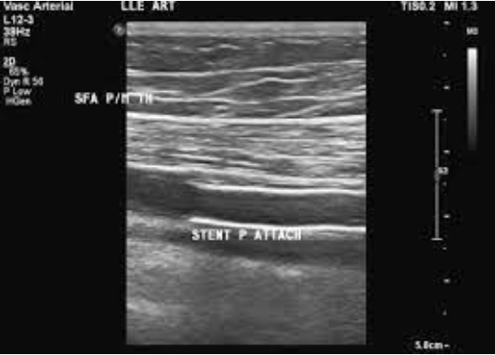 <p>Patient presents for f/u ultrasound exam. She is s/p stent placement x 3 weeks.&nbsp;</p><p>Describe your imaging protocol.&nbsp;</p>