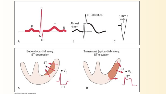 <ul><li><p>ST seg elevation</p></li><li><p>T wave inversion</p></li><li><p>Development of Q wave</p></li></ul><p><br>T wave + ST seg, ventricular repolarization USUALLY first affected by myocardial ischemia + infarction</p><p></p><p></p>