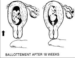 <p>Palpation of a floating fetus by bouncing it gently and feeling for a rebound</p>