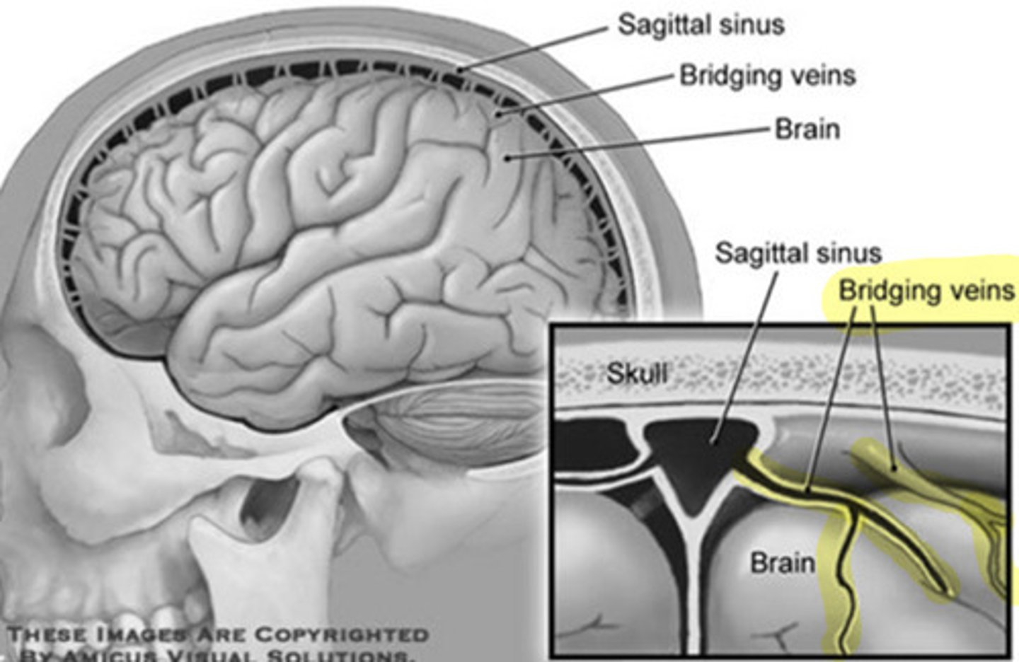 <p>• Head trauma</p><p>• Post-surgical complications</p><p>• Anticoagulation drug therapy</p><p>• Nontraumatic cerebral aneurysm</p>