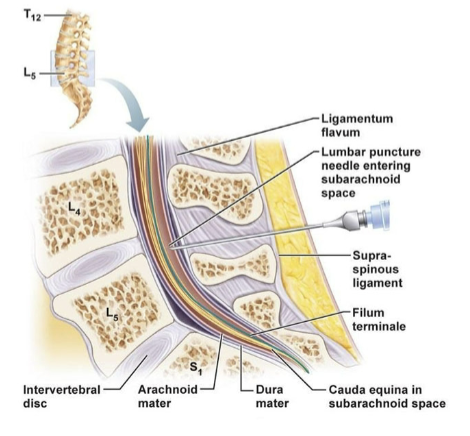 <p>Lumber punctures go deeper. Through the dura and arachnoid and into the subaracnoid space</p>