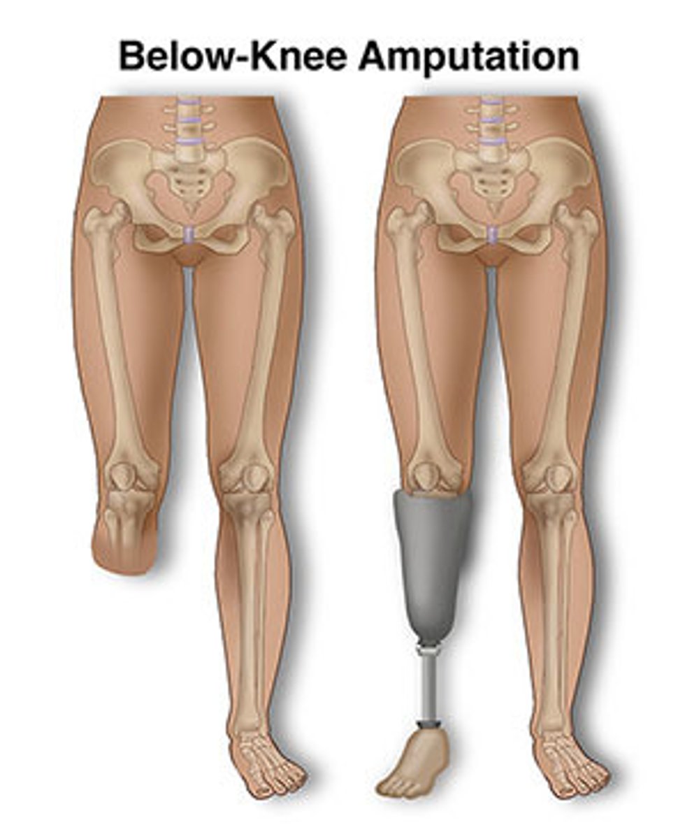 <p>Transtibial amputation</p>