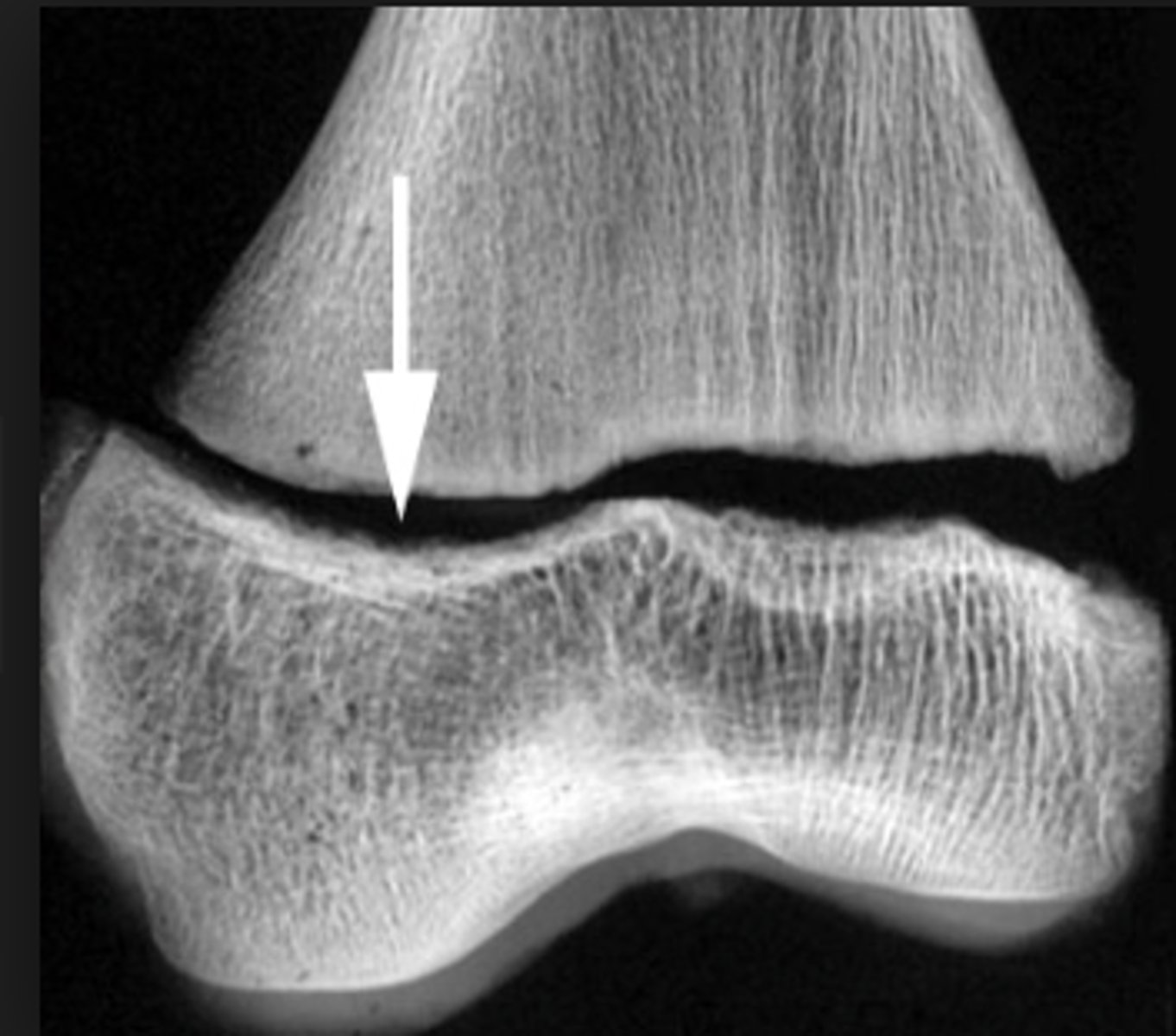 <p>a break at the location of the growth plate, which can affect growth of the bone</p>