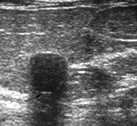 <p>Posterior Shadowing</p>