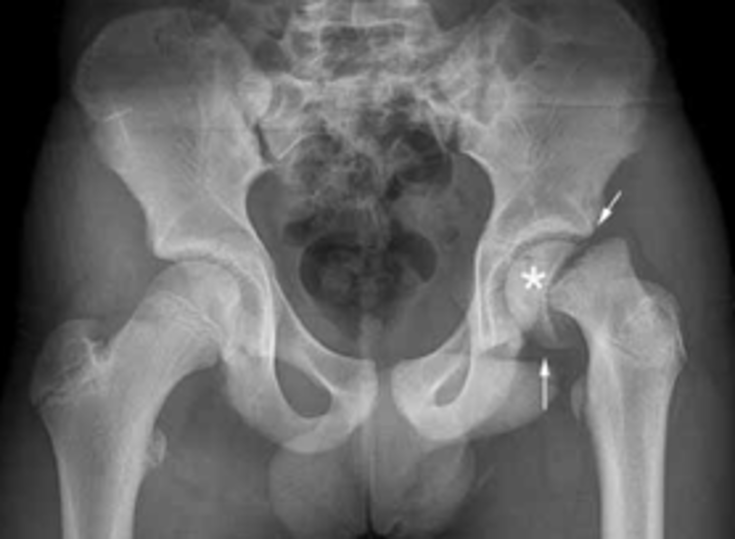 <p>- femoral epiphysis slips posteriorly <br>- blurring of physis on AP pelvis view<br>- use lateral frog view</p>