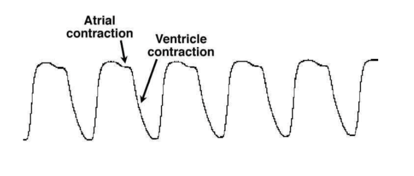 <ul><li><p>Atrial contraction→ associated with small downward deflection of lever arm of mechanical transducer</p></li><li><p>Ventricular contraction→ associated with <strong>much larger</strong> downward deflection of the arm </p></li></ul><p></p>