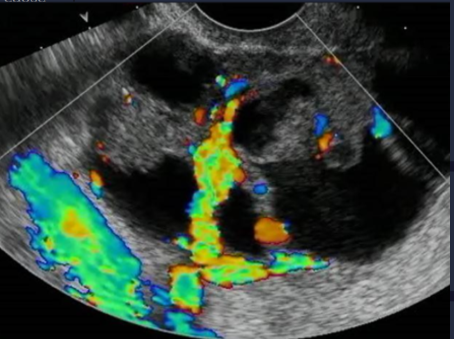 <p>Ovarian ______  is the leading cause of death from gynecologic malignancy (____)</p>