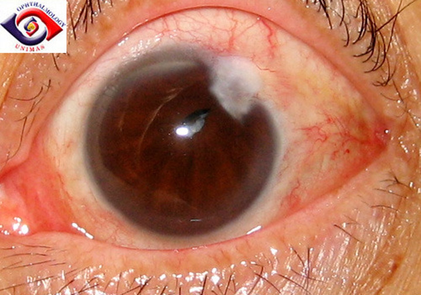 <p>Corneal scar</p>