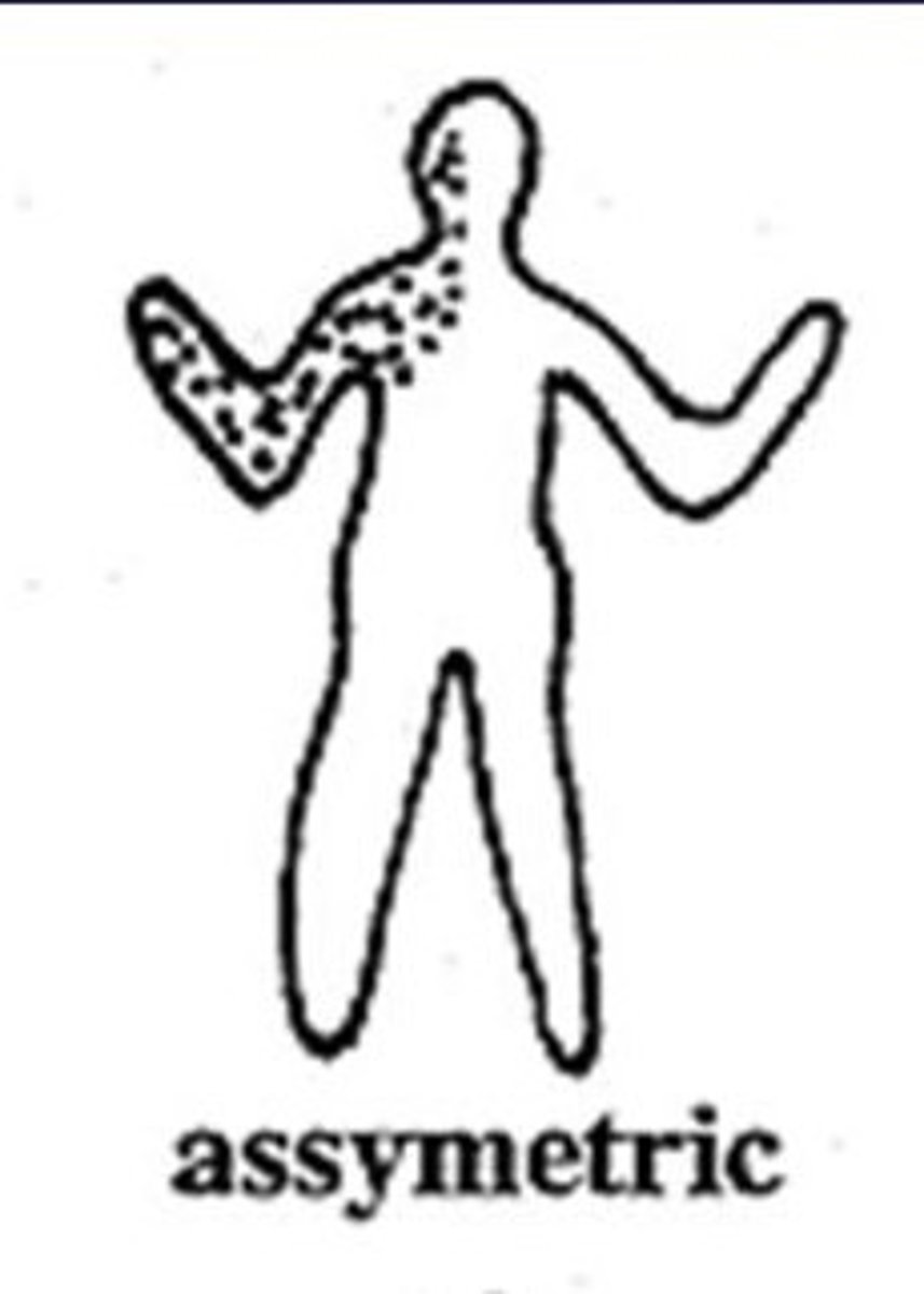 <p>Lesions are not distributed in a symmetrical pattern</p>