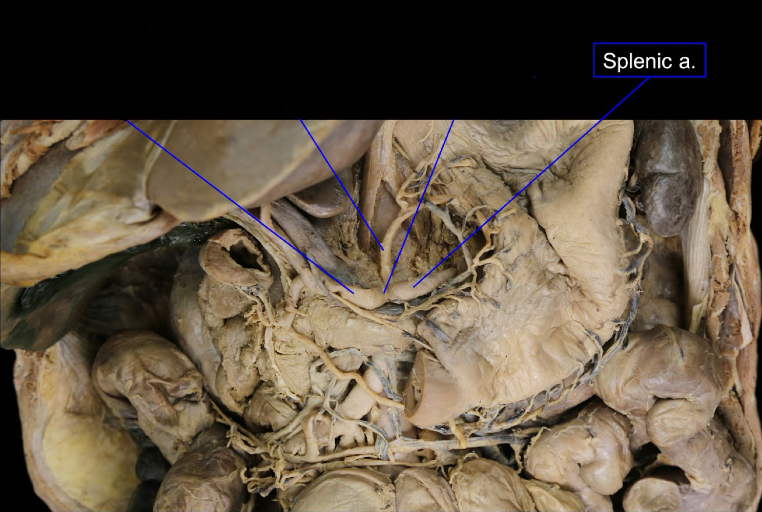 <p>A). Splenic artery<br>B). the spleen<br>C). celiac trunk of the abdominal aorta</p>