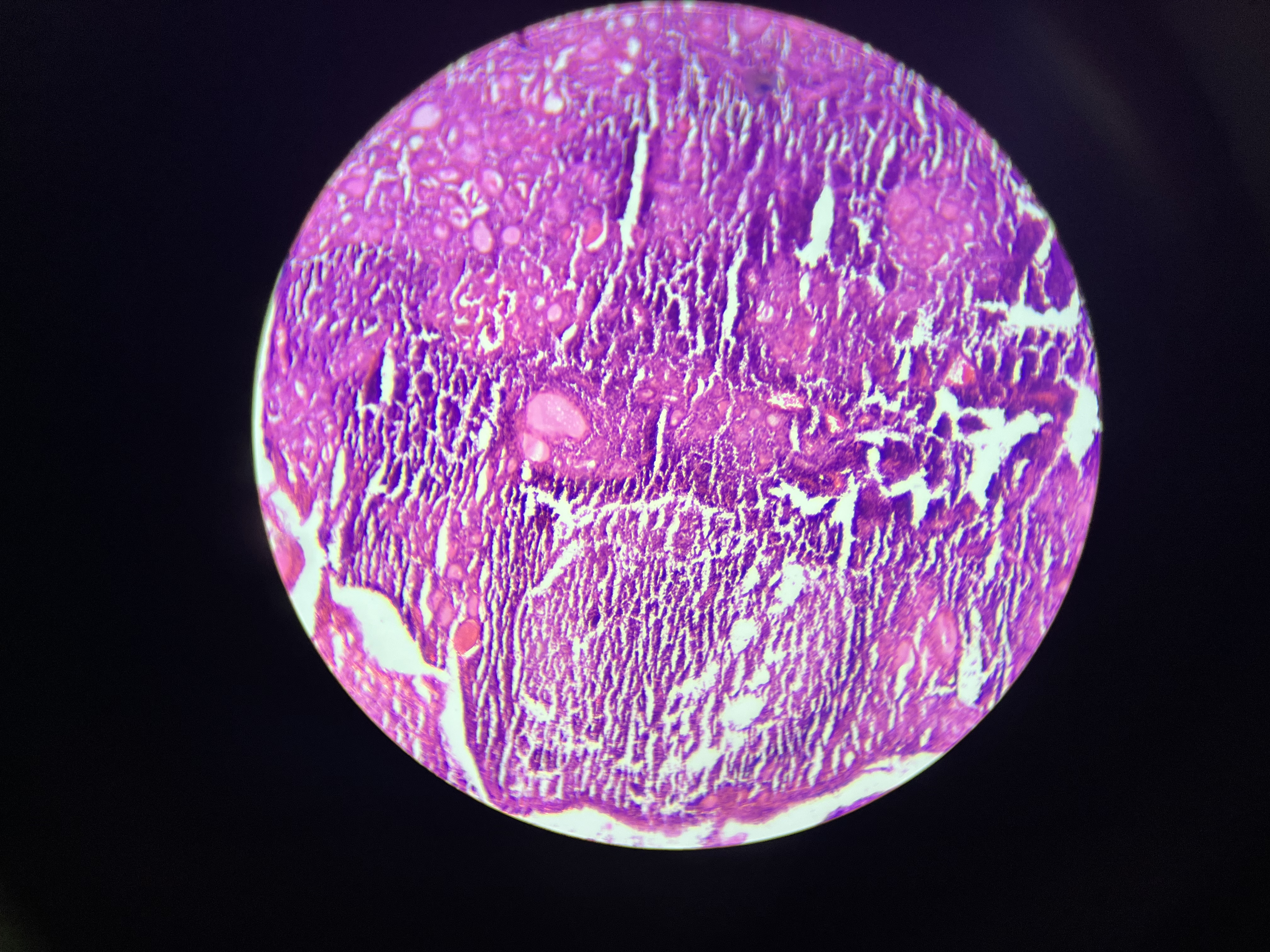 <ul><li><p>Histomorphologic findings include significant lymphocytic infiltration of the thyroid gland, characterized by the presence of germinal centers, which are areas of active B-cell proliferation. </p></li><li><p>The infiltrate often leads to destruction of the thyroid follicles, causing a reduction in hormone production. Patients often present with thyroid enlargement (goiter), fatigue, weight gain, and sensitivity to cold due to decreased metabolic rate.</p></li></ul><p></p>