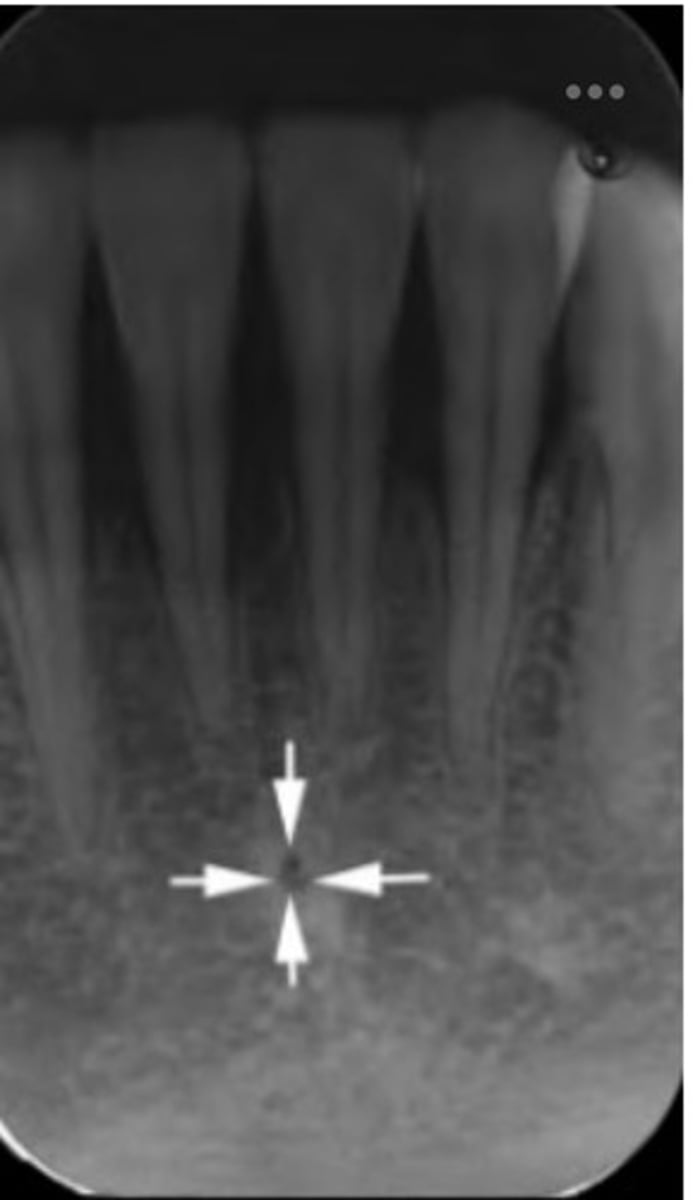 <p>1. Identify the radiolucent area where the arrows are pointing.</p><p>2. Identify the radiopaque area where the arrows are pointing.</p>