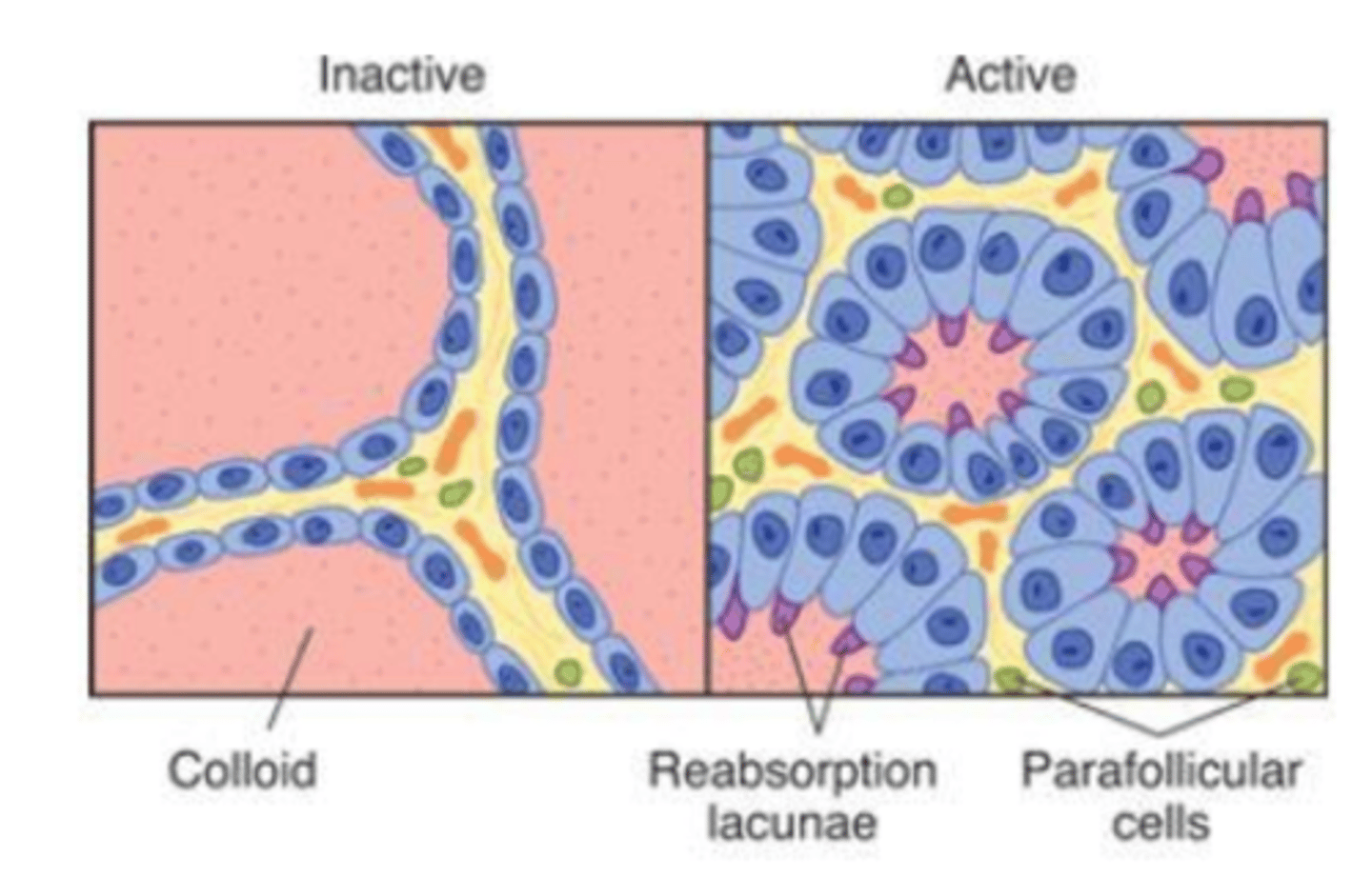 <p>folikuli ir mazi, bet tirocīti ir kubiski vai stabveida (cuboid or columnar) un ir redzamas zonas «reabsorption lacunae», kurās koloīds tiek aktīvi reabsorbēts.</p>