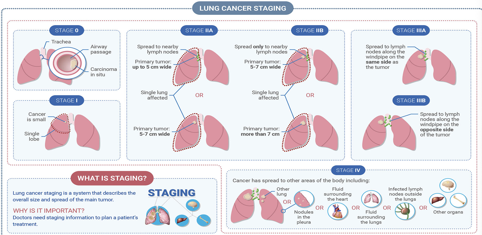 <p>T: tumor size and level of invasion of adjacent structures</p><p>N: presence or absence of nodal spread and site of nodal spread</p><p>M: presence or absence of distant metastases</p><p>-Stage 0: carcinoma in situ</p><p>-Stage 1: small cancer at single lobe</p><p>-Stage 2a: spread to nearby lymph nodes, primary tumor up to 5 cm wide, single lung affected or primary tumor 5-7 cm wide</p><p>-Stage 2b: spread only to nearby lymph nodes, single lung affected or primary tumor more than 7 cm</p><p>-Stage 3a: spread to lymph nodes along the windpipe on same side as tumor</p><p>-Stage 3b: spread to lymph nodes along the windpipe on opposite side of tumor</p><p>-Stage 4: spread to other areas of body include other lung or nodule in pleura or fluid surrounding lungs or infected lymph nodes outside the lung or other organs</p>
