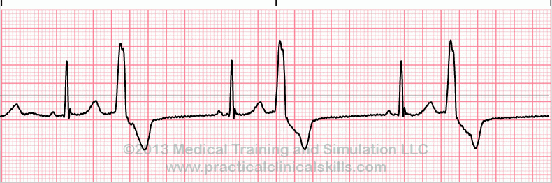 <p>what is this heart rhythm?</p>