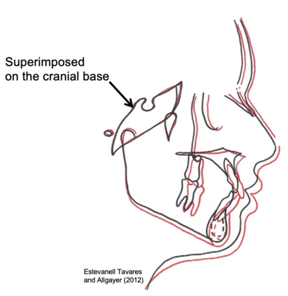 <p>Serial cephs are superimposed on the developmentally stable cranial base</p>