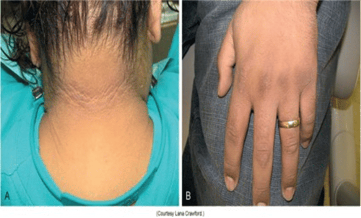 <p>thickening and darkening of skin near axillary region, associated with Diabetes Type II and gastric carcinoma</p>