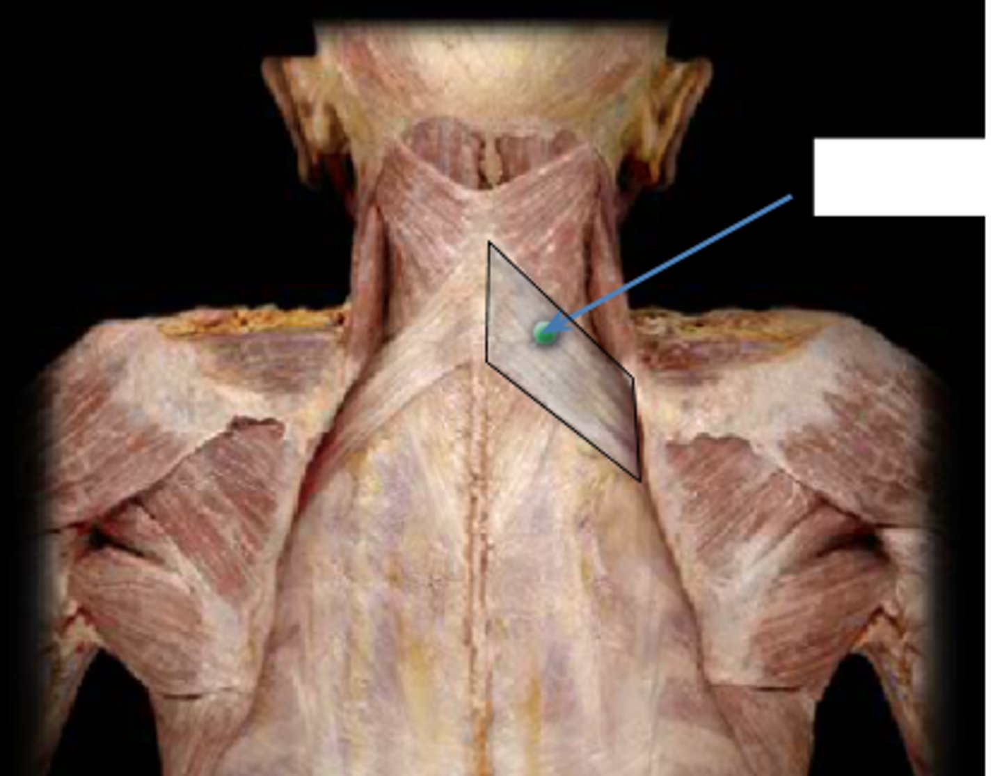 <p>Lower cervical and upper thoracic vertebrae, elevates ribs, and respiration</p><p>Innervation = intercostal nerves; T1-T4</p><p>deep to rhomboid but still a superficial back muscle</p>