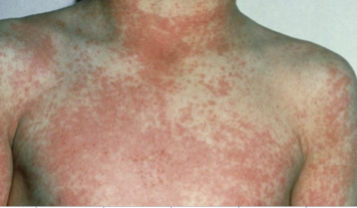 Hives all over body