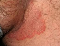 <p>= fungal infection in the crural fold from sweating or wearing layers of occlusive clothing</p><ul><li><p>forms a red-brown half-moon shape w well-defined borders</p></li><li><p>“jock itch”</p></li></ul>