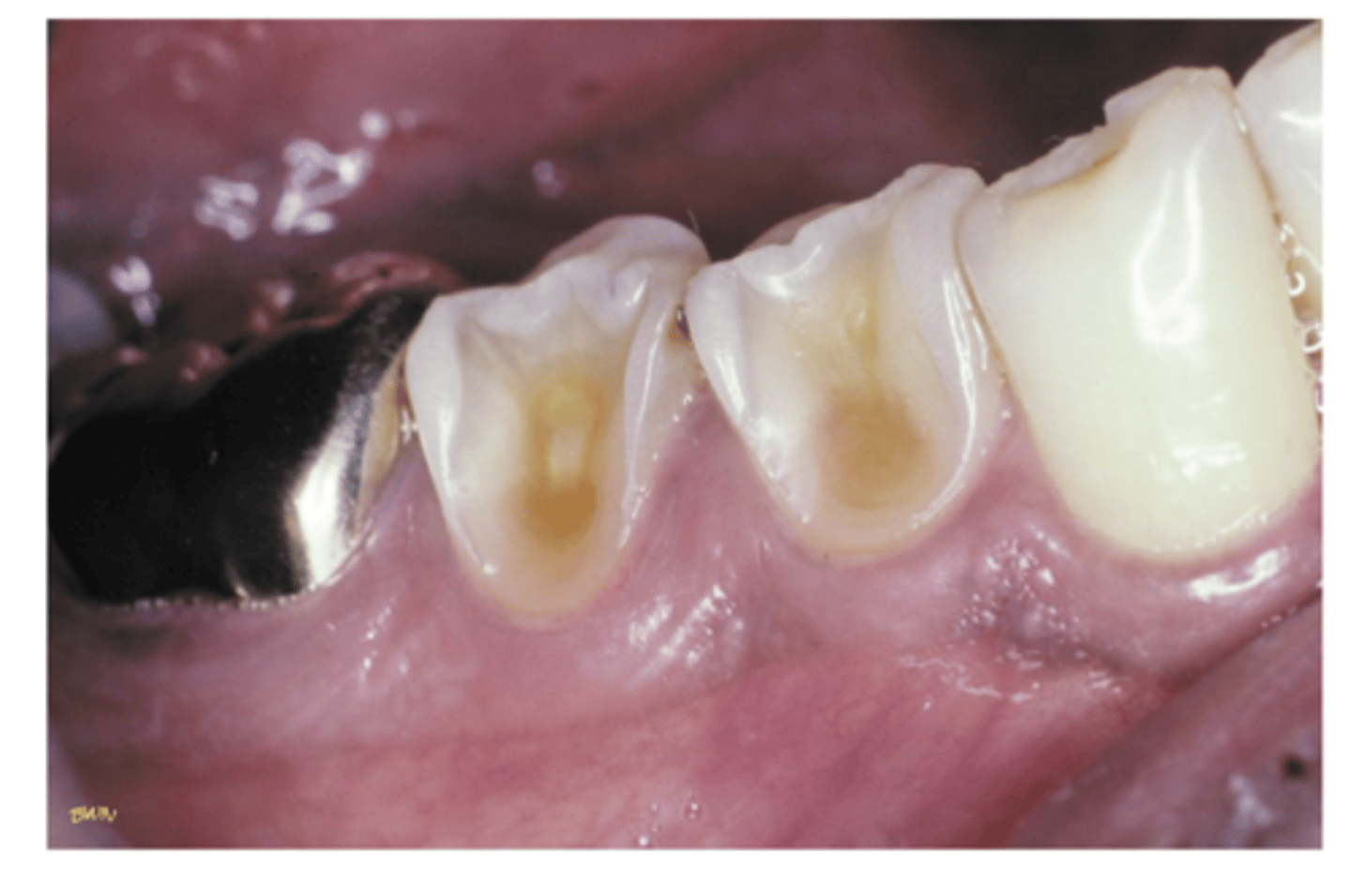 <p>loss of tooth structure due to chemical actions --> chemicals, acidic food and drink, meds, pools with low ph, gastric secretions, eating disorders, etc</p><p>commonly affects facial and lingual surfaces and palate</p><p>appears smooth and polished</p>