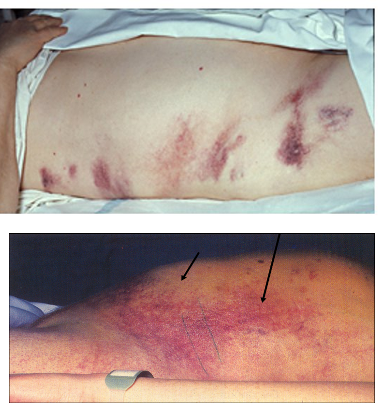 <p>Green brown discoloration to flanks seen with severe, necrotizing pancreatitis </p>