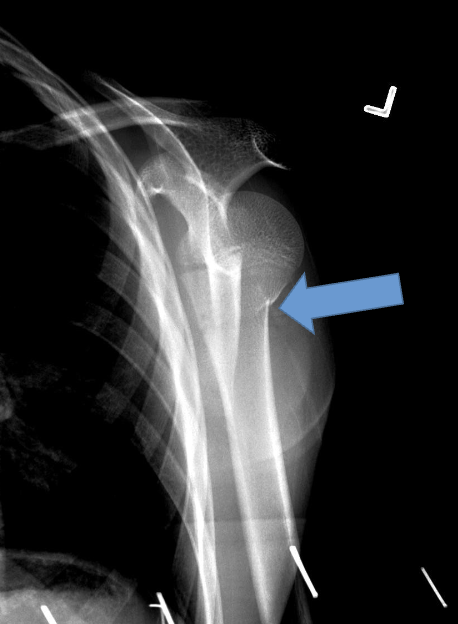 <p>What type of fracture is this? (Bonus points for full explanation)</p>