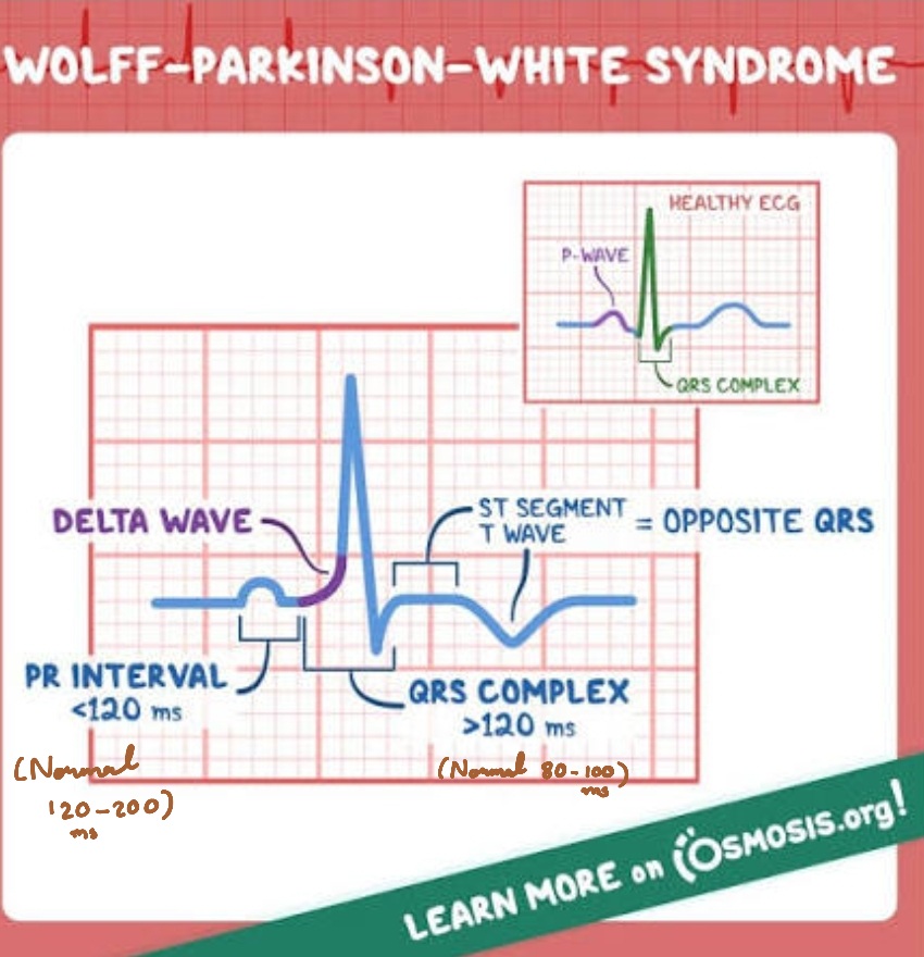 <ol><li><p>Short PQ/PR-interval</p></li><li><p class="has-focus">Delta wave</p></li><li><p class="has-focus">Slightly widened QRS</p></li><li><p class="has-focus">Secondary ST/T abnormalities</p></li></ol><p></p>