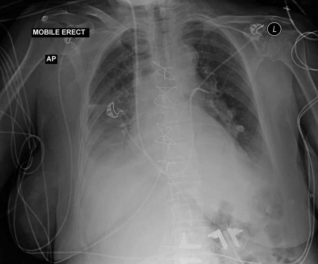 <p>Assist with mobile imaging for placement and ensure careful positioning without dislodging the catheter. (Image - Swan-Ganz in Left Pulmonary Artery)</p>
