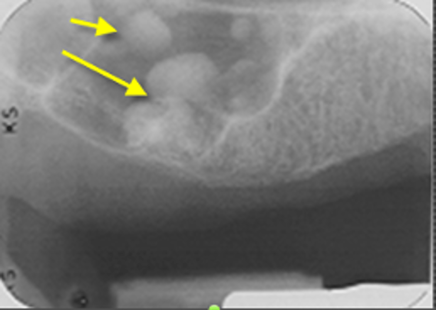 <p>ID the calcified abnormality:</p>