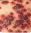 <p>• Dark red/brown raised nodules or patches</p><p>• Kaposi sarcoma</p><p>• In HIV/AIDS patients, CD4 &lt;200</p>