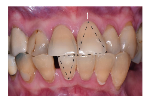 <ol><li><p>Slender, triangular shaped crown </p></li><li><p>Thin, delicate soft tissue with thin alveolar bone</p></li><li><p>Narrow zone of keratinized tissue </p></li><li><p>Accentuated scalloped gingival margin contour. </p></li></ol><p><em>**greater tendency for onset and progression of mucogingival deformities. </em></p><p></p>